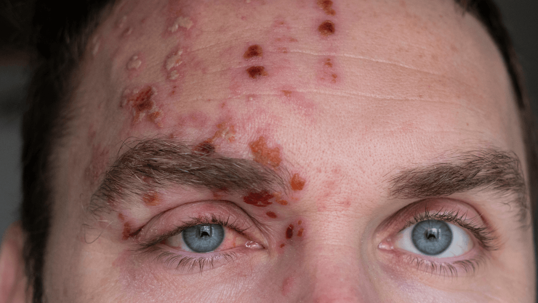 Shingles - more than just a rash